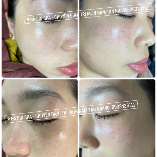 Hà Bin Spa_Chuyên điều trị mụn-nám-tàn nhang - Spa Trị Mụn tại Thủy Nguyên, Hải Phòng