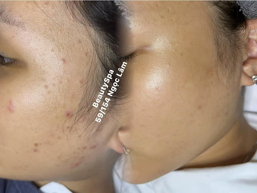 Beauty Spa - Spa Trị Mụn tại Long Biên, Hà Nội