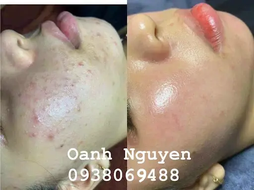 Oanh Spa Trị Mụn - Spa Trị Mụn tại Tây Hồ, Hà Nội