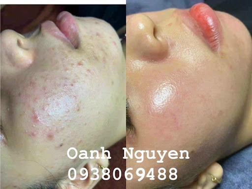 Oanh Spa Trị Mụn - Spa Trị Mụn tại Phúc Thọ, Hà Nội