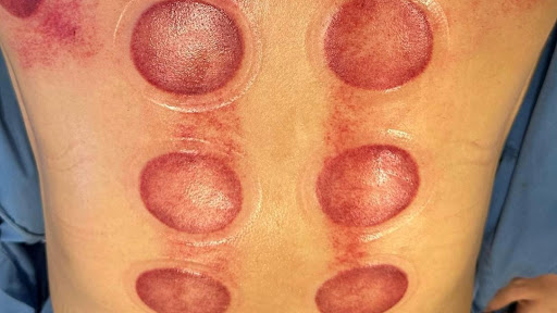 Massage Châm Cứu Bấm Huyệt Trị Liệu Hoa Spa - Spa Massage tại Bảo Lộc, Lâm Đồng