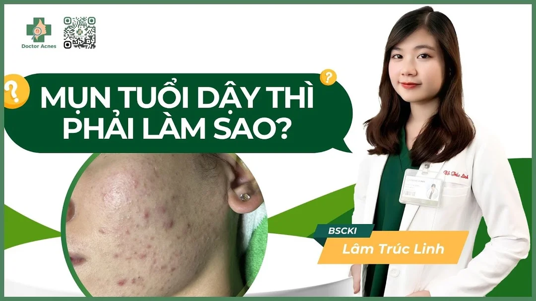 Bác sĩ giải thích mụn tuổi dậy thì phải làm sao