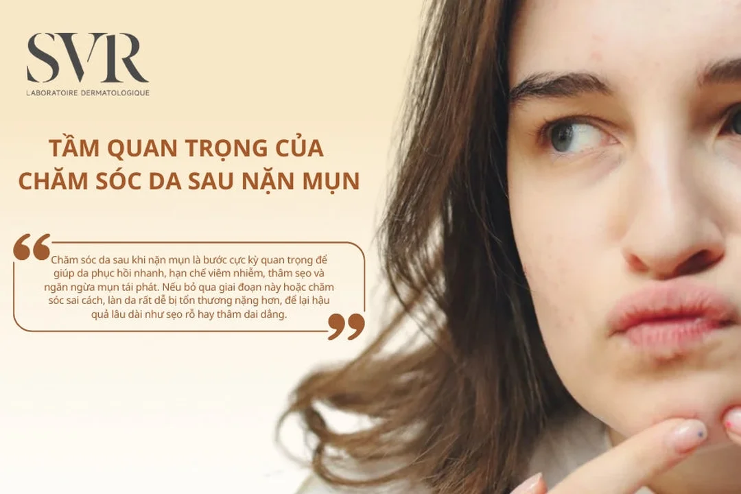 da sau nặn mụn dễ tăng sắc tố sau viêm