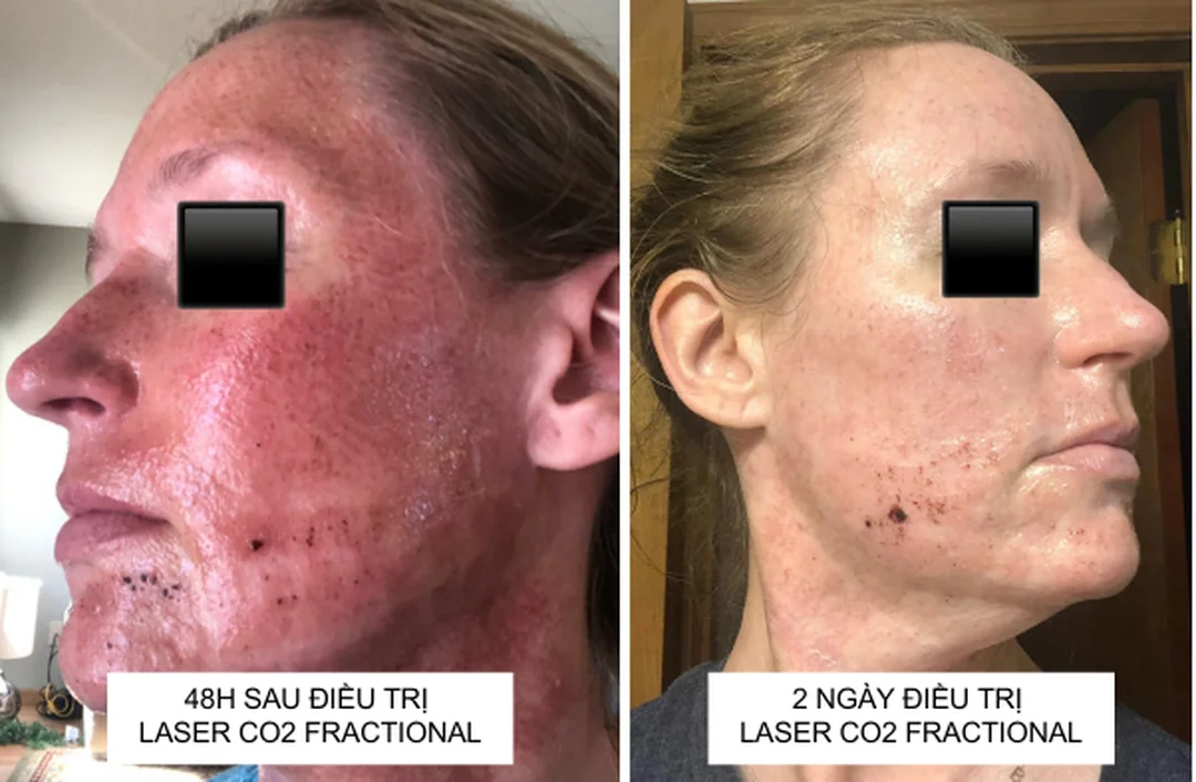 dấu hiệu cần tái khám khi chăm sóc da sau laser co2 dấu hiệu cần tái khám khi chăm sóc da sau laser co2