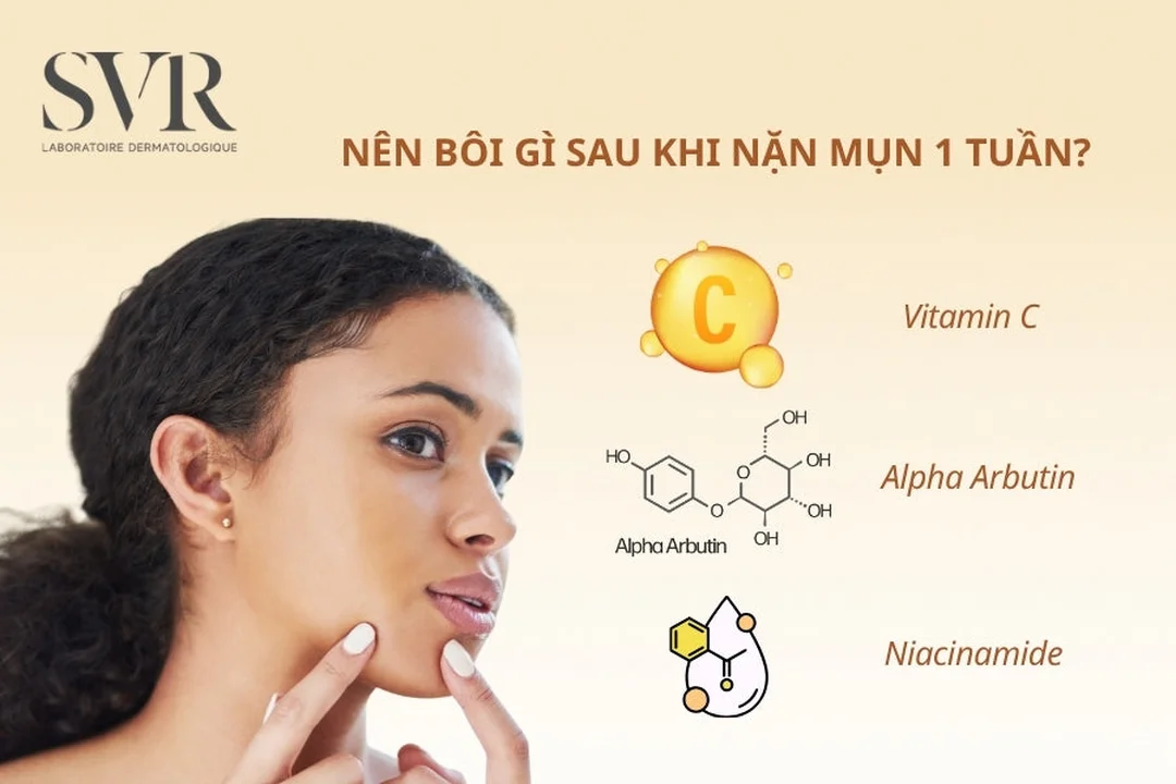 khi nào dùng treatment lại sau nặn mụn