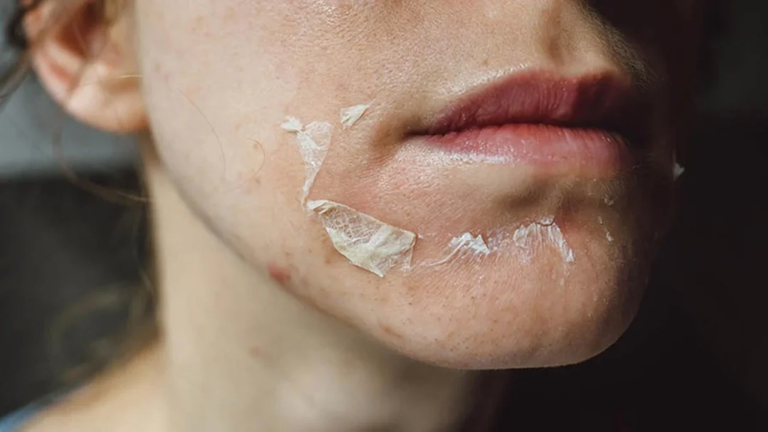 những điều cần tránh khi chăm sóc da sau peel