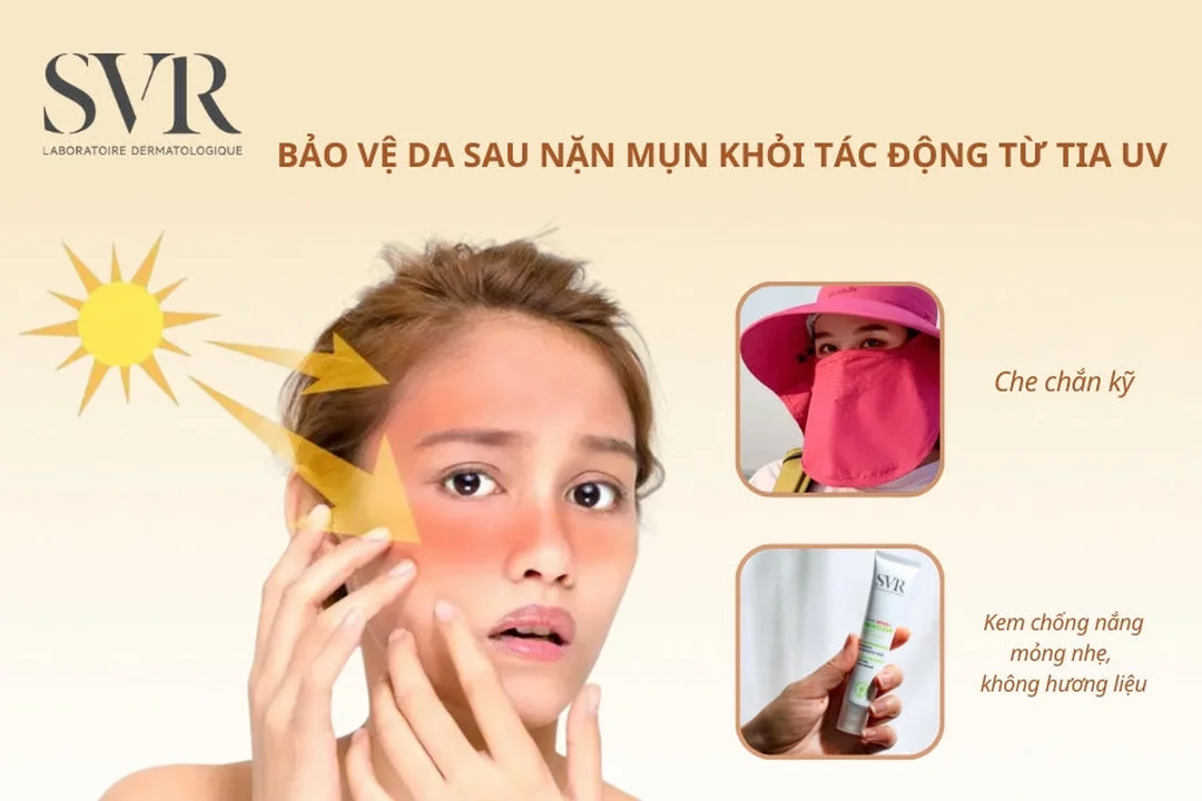 sai lầm khi chăm sóc da sau nặn mụn