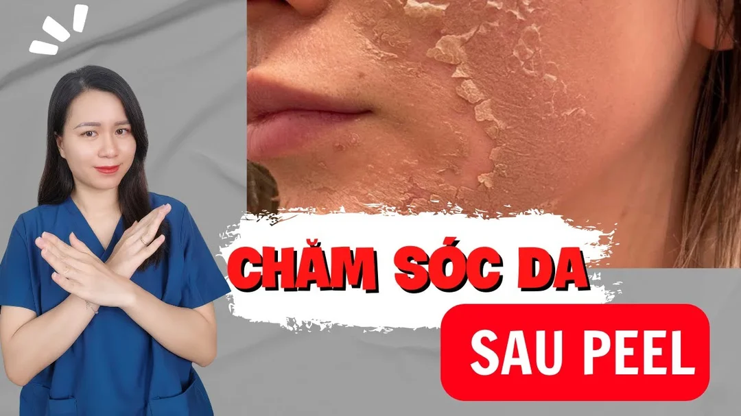 Sau khi peel da nên dùng sản phẩm gì? Chăm sóc da sau peel