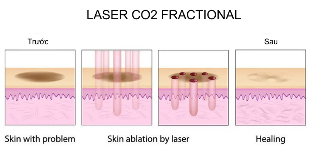 so sánh chăm sóc da sau laser co2 fractional và ablative