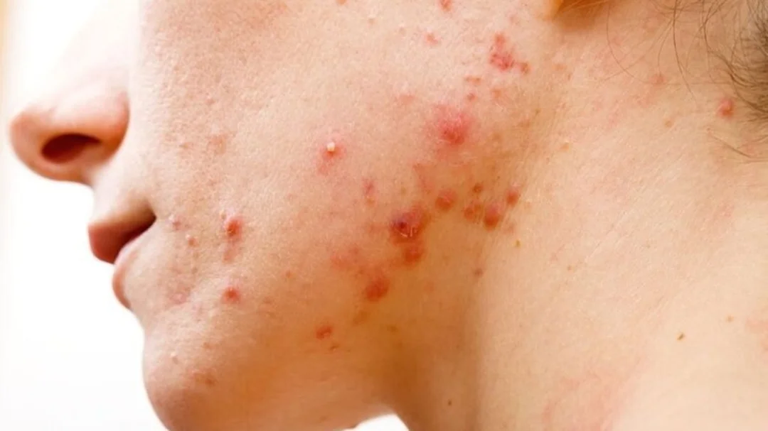 cách chăm sóc da mặt hằng ngày sai cách làm mụn nặng hơn