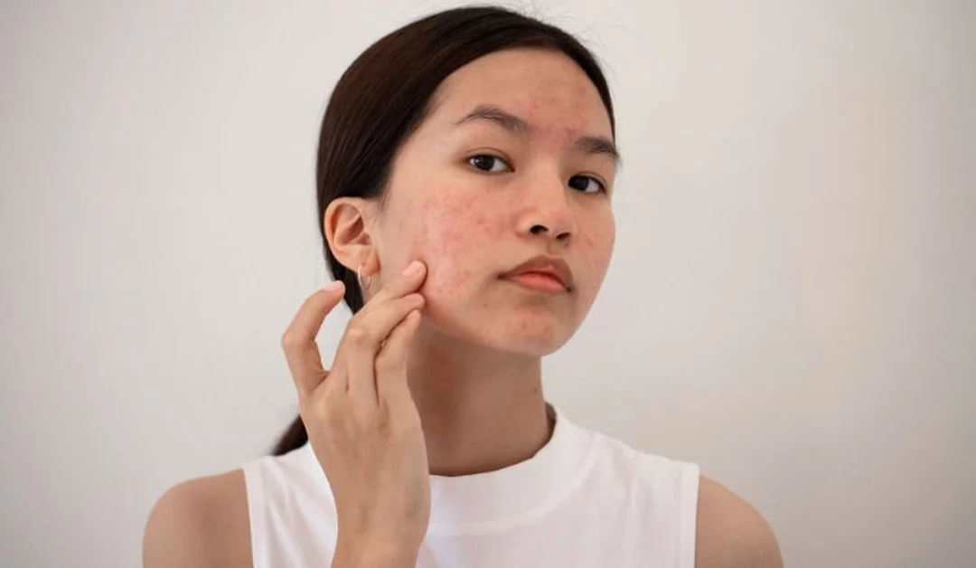 quy trình chăm sóc da mụn hàng ngày cho da có mụn đầu trắng và mụn viêm