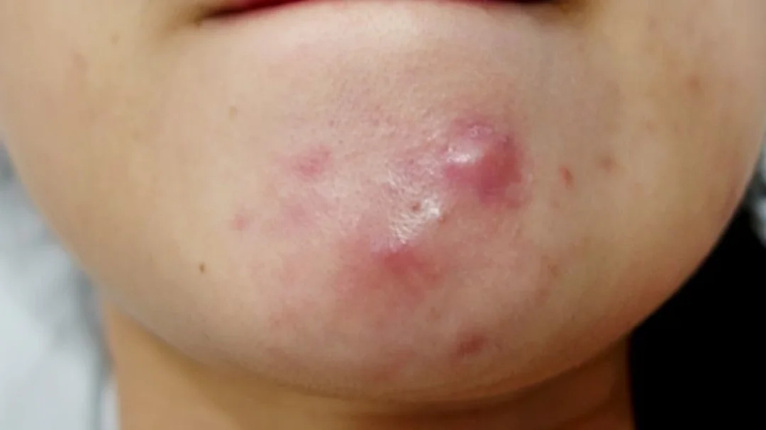 quy trình chăm sóc da mụn hàng ngày cho vùng mụn viêm sưng đỏ
